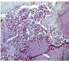 Gambar 1. Imunohistokimia galectin-3 pada kasus karsinoma papiler. A. Intensitas pulasan kuat