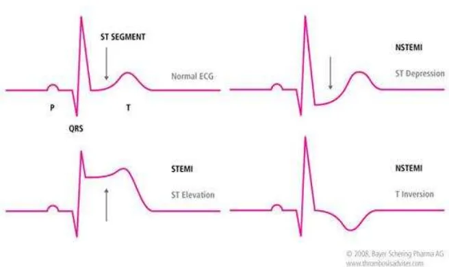 Gambar 4. Perbedaan Khas Gelombang EKG Infark Miokardium PJK41