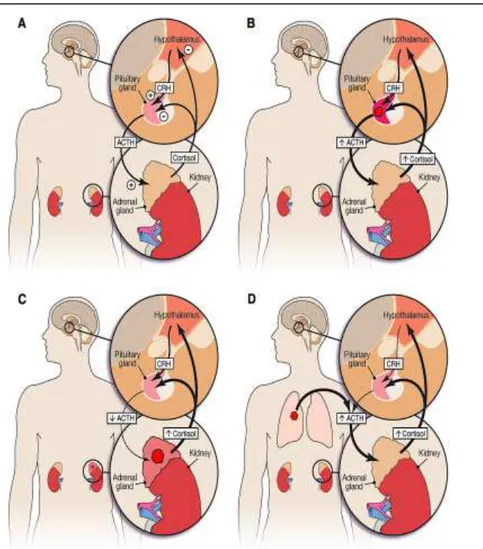 Gambar  1.  Perbedaan  aksis  hipotalamus-pituitari-adrenal  (HPA)  antara  orang  normal  dan  penderita  Sindrom  Cushing