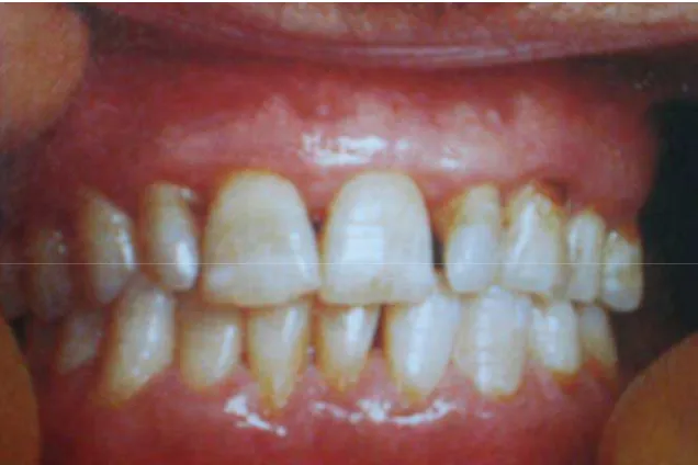 Gambar 2.6. Peradangan pada gusi karena kurang perawatan gigi 