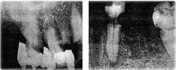 Gambar 2 . Karies servikal yang disebabkan terapi radiasi. Gambar diambil kurang dari setahun setelah terapi radiasi.11 