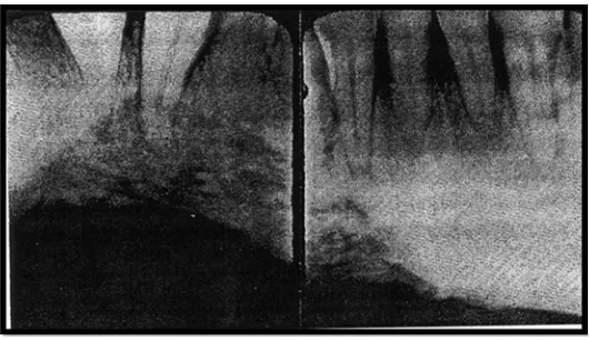 Gambar 3. Osteoradionekrosis setelah menjalani terapi radiasi selama 5 tahun.11 