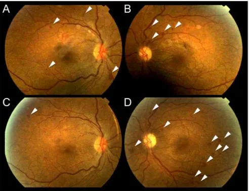 Gambar 2. Gambaran funduskopi pada pasien retinopati diabetika. 