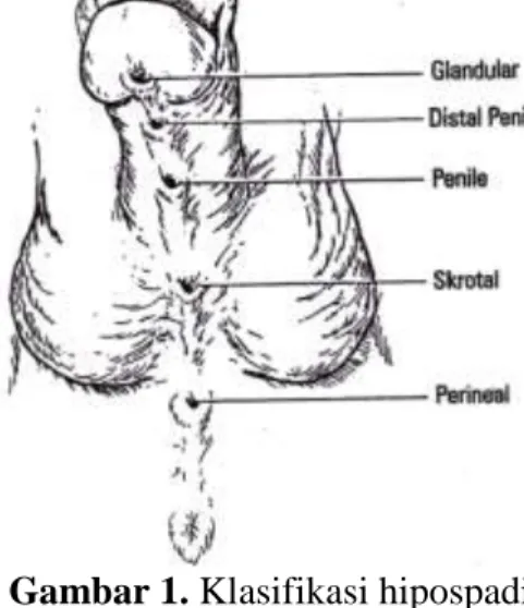 Gambar 1. Klasifikasi hipospadia 