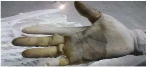 Gambar  3  :  kulit  yang  telah  dilepas  dari  tangan  jenazah 10