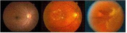 Gambar 2.1 Perbandingan retina normal dan penderita diabetes mellitus 