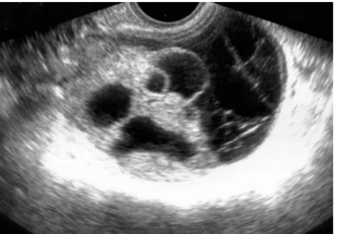 Gambar 2.6. Asites mengelilingi ovarium yang membesar.1 