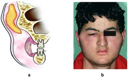 Gambar 2.7 :  a. Ilustrasi gambar penyebaran abses ke rongga infratemporal     b. Tampakan klinis 