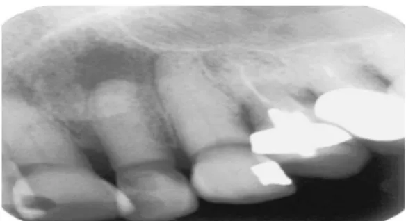 Gambar 2.3. Gambaran radiografi dari abses periapikal akut  Sumber : Ingle J.I. Endodontics 5th ed