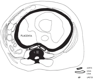 Gambar  5. Potongan melintang uterus gravidus. Uterus menekan pembuluh  darah besar disamping vertebra sehingga terjadi oklusi aliran darah  (Sumber 