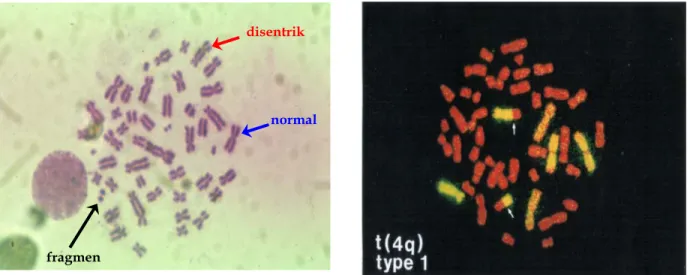 Gambar 3. Aberasi kromosom pada sel darah limfosit manusia. Kiri, kromosom  asentrik, cincin dan disentrik