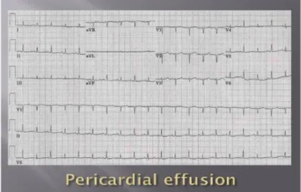 Gambar 4 : EKG menunjukkan kompleks QRS low-voltage dan electrical  alternans 