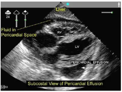 Gambar : FAST Subcostal Abnormal : tampak adanya celah hitam di berada diantara  lapisan dinding jantung yang diduga cairan dalam kantung pericardial (17) 
