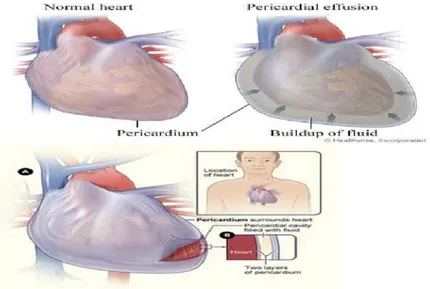 Gambar 2 : Jantung normal dan efusi pericardium 
