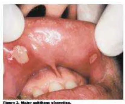 Gambar 2. Stomatitis aftosa rekuren tipe  mayor 24 