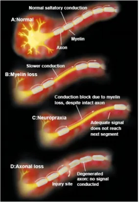 Gambar menunjukkan bagian pada  tangan yang diinervasi pleksus  branchial yang akan terpengaruh  apabila menderita Sindrom Karpal  Tunnel