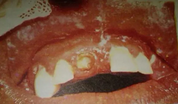 Tabel 1. Tipe Klinis Candidiasis 