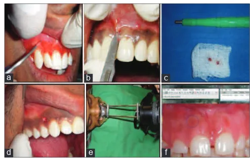 Figure 1: Pre- and post-operative view following gingival depigmentation (right side maxillary gingiva treated with diode laser and left side maxillary gingiva treated with surgical blade)