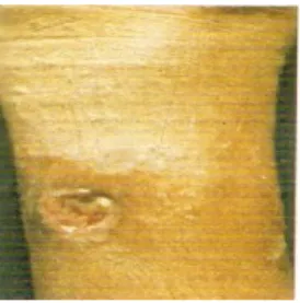 Gambar 2.5 Ulkus Tropikum 