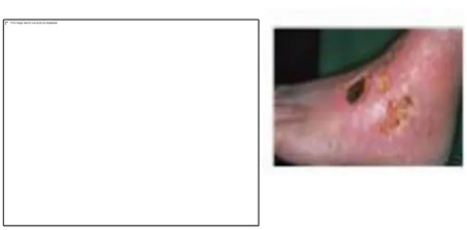 Gambar 3. Ulkus Arteriosum 