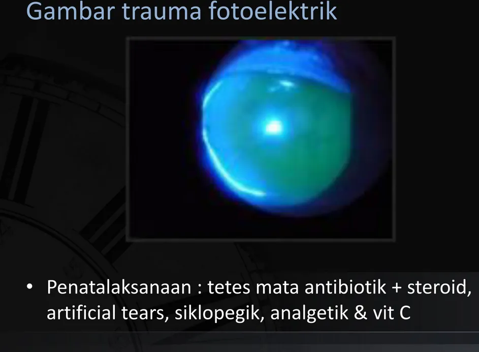 Gambar trauma fotoelektrik 