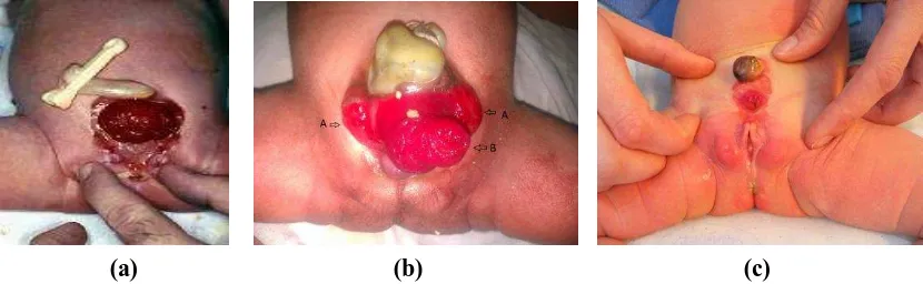 Gambar 1.   Variasi kelainan exstrophy-epispadias complex:    (a) Bayi perempuan baru lahir dengan classic bladder exstrophy dan klitoris bifida ; (b) Bayi laki-laki baru lahir dengan cloacal extrophy, dengan kandung kemih dan prolaps ileum yang terekspos.(c) Bayi perempuan baru lahir dengan variant bladder extrophy, superior vesical fissure.2,6 