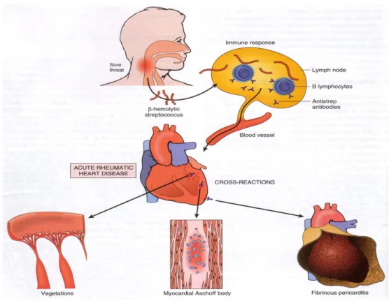 Gambar 2.3 Patofisiologi penyakit jantung rematik