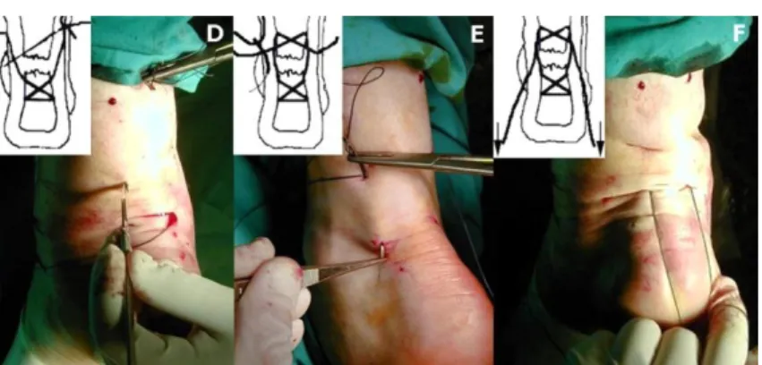 Gambar 2.9: Open Surgical Repair 