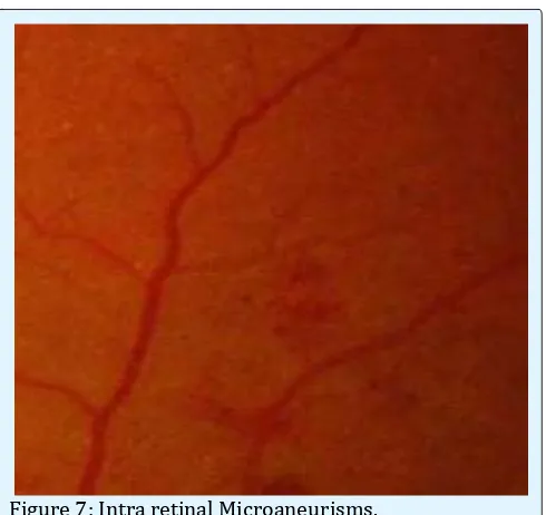 Figure 7: Intra retinal Microaneurisms. 