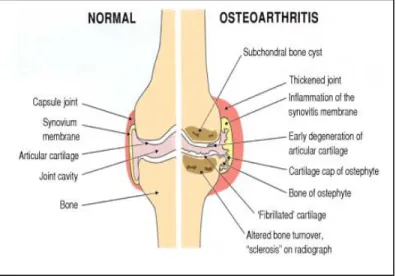 Gambar 2.1.  Lutut Normal dan Lutut Osteoarthritis  (Kuntono, 2011) 