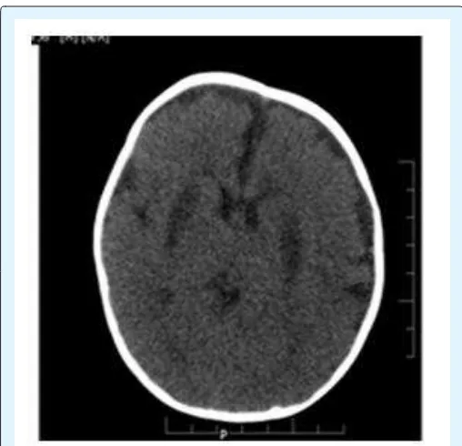 Figure 2: CT Brain (Plain) at the level of basal ganglia  showed bilateral symmetrical hypodensities noted in the putamen
