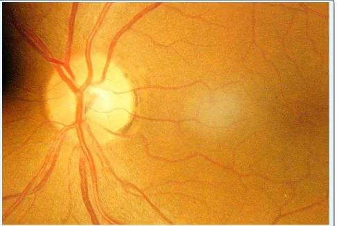 Figure 1: The photography of the ocular fundus, shows the optic nerve (blue arrow), the macula (yellow arrow), and the melanin in the temporary edge of the optic nerve (black arrow)