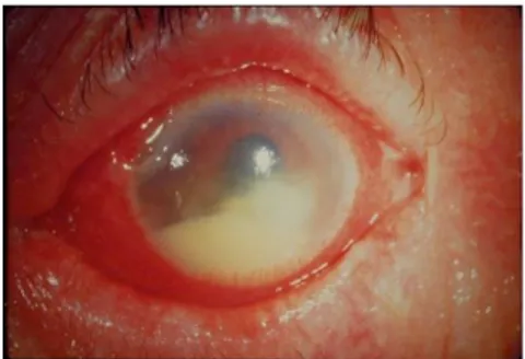 Gambar 8. Keratitis Aspergilus  Gambar 9. Keratitis Candida 