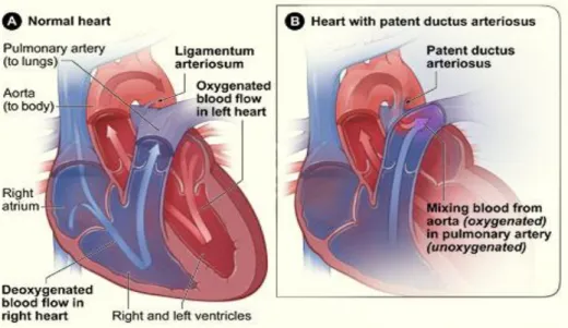 Gambar 1. Anatomi Jantung Normal dan Duktus arteriosus persisten. 24