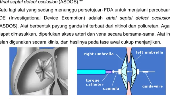 Gambar 13. Atrial septal defect occlusion 