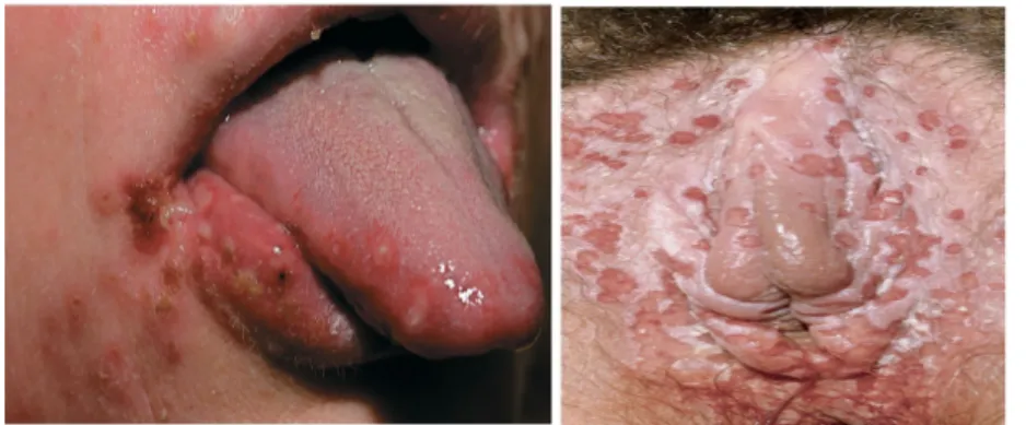 Gambar   10.  Herpes   labial   (kiri),   dan   herpes  genital   feminina   (kanan) (Prawirohardjo, 2009).
