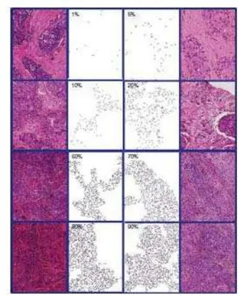 Gambar 2.3.  Standar penilaian TILS pada kanker Payudara 