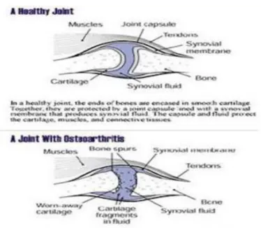 Gambar 1 anatomi sendi lutut yang sehat dengan terserang osteoarthritis 