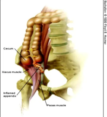 Gambar 5. Dasar anatomis terjadinya Psoas sign  10