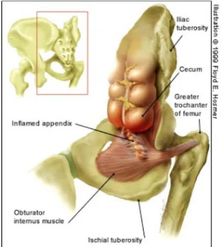 Gambar  7. Dasar anatomis Obturator sign 10)