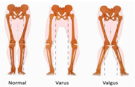 Gambar 3. Bentuk Kaki Normal dan Abnormal Komplikasi