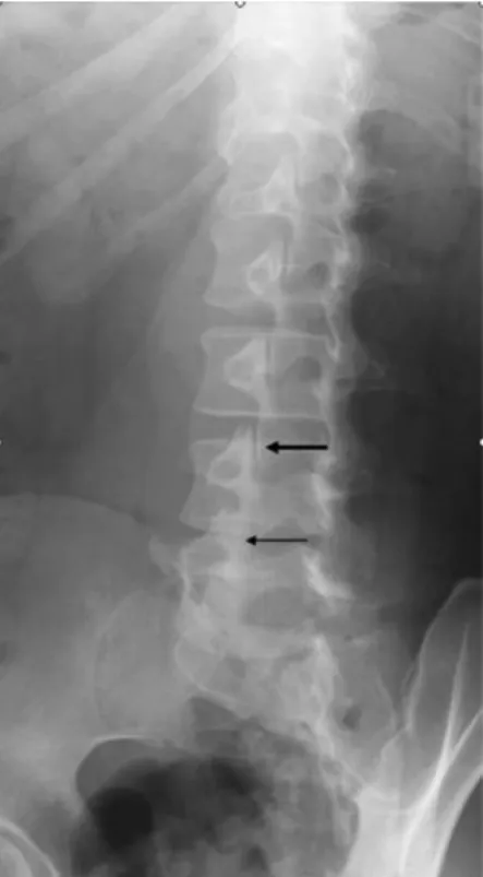 Gambar 2.2 Gambaran foto polos oblik tulang belakang lumbal. 