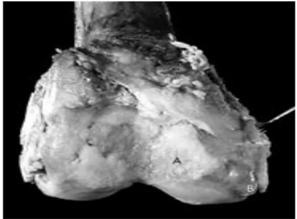 Gambar 1. Gambaran Radiologik Osteoartritis Lutut 