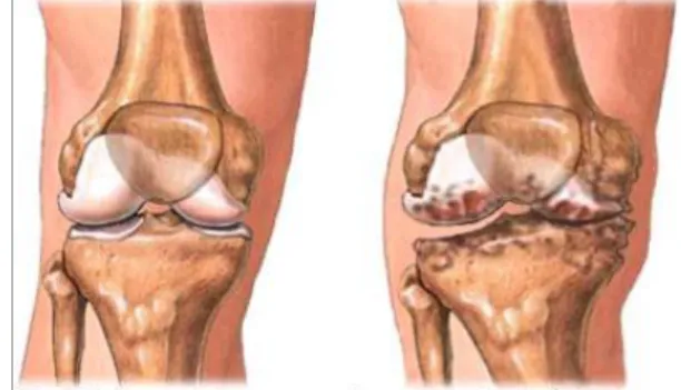 Gambar : Perbandingan sendi sehat dan sendi yang terkena Osteosrtritis 