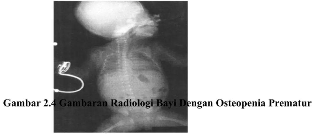 Gambar 2.4 Gambaran Radiologi Bayi Dengan Osteopenia Prematur 