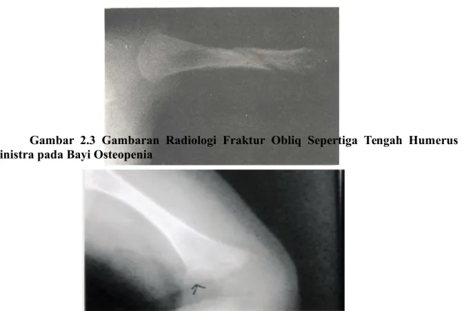 Gambar  2.3   Gambaran   Radiologi   Fraktur   Obliq   Sepertiga   Tengah   Humerus Sinistra pada Bayi Osteopenia 