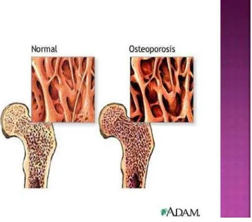 Gambar 3 Gambaran tulang pada orang normal dan osteoporosis 37