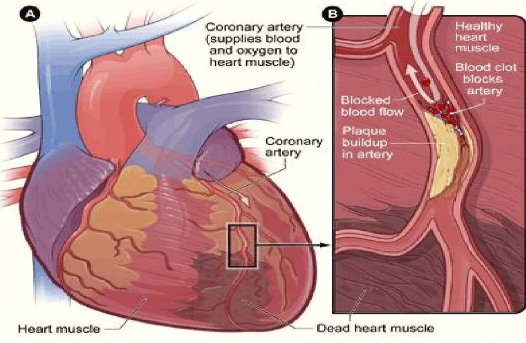 Figure A is an overview of a heart and coronary artery showing damage (dead heart  muscle) caused by a heart attack