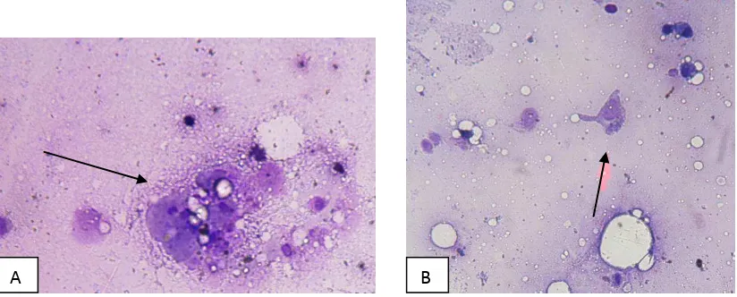Gambar 4.1. Mikroskopik sel yang terlihat dari bubur tumor. (A)(B)Sel epitel 