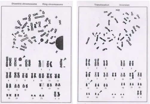 Gambar 6. Aberasi kromosom pada sel darah limfosit manusia. Kanan, kromosom  asentrik, cincin dan disentrik